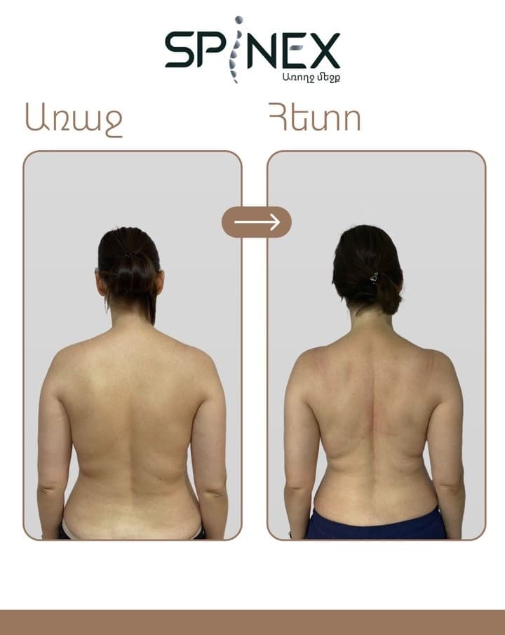«Առաջ» և «Հետո» համեմատություն՝ մասնակցի մեջքի կեցվածքը Spinex-ի ծրագրի ընթացքում